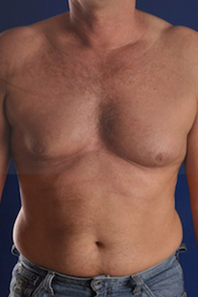 Hi-Def Liposuction Before & After Image