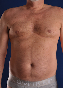 Hi-Def Liposuction Before & After Image