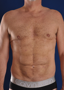 Hi-Def Liposuction Before & After Image