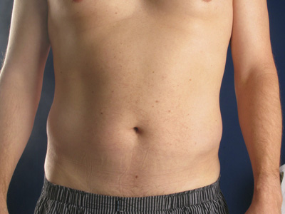 Hi-Def Liposuction Before & After Image