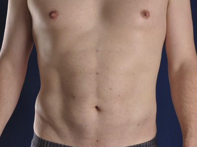 Hi-Def Liposuction Before & After Image