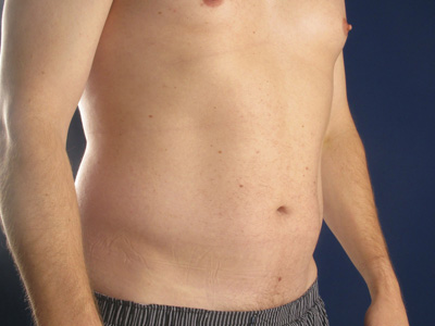 Hi-Def Liposuction Before & After Image