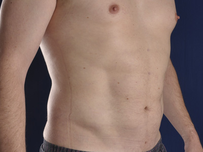 Hi-Def Liposuction Before & After Image