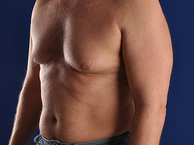 Hi-Def Liposuction Before & After Image