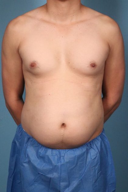 Hi-Def Liposuction Before & After Image