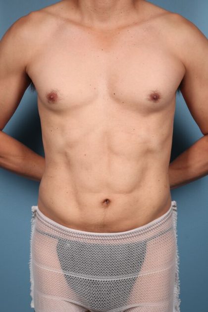 Hi-Def Liposuction Before & After Image