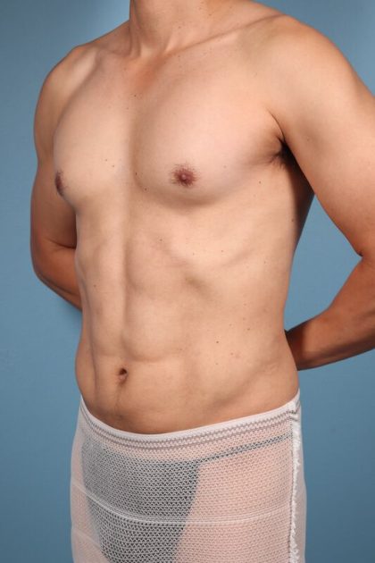 Hi-Def Liposuction Before & After Image