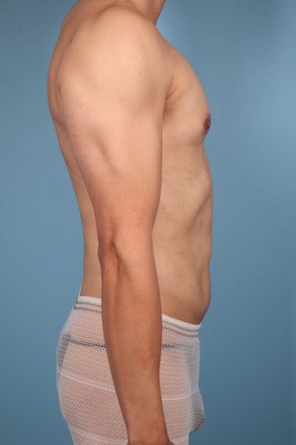 Hi-Def Liposuction Before & After Image