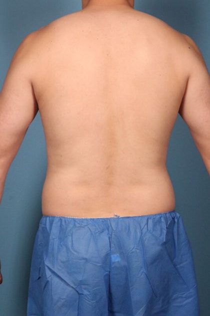 Hi-Def Liposuction Before & After Image