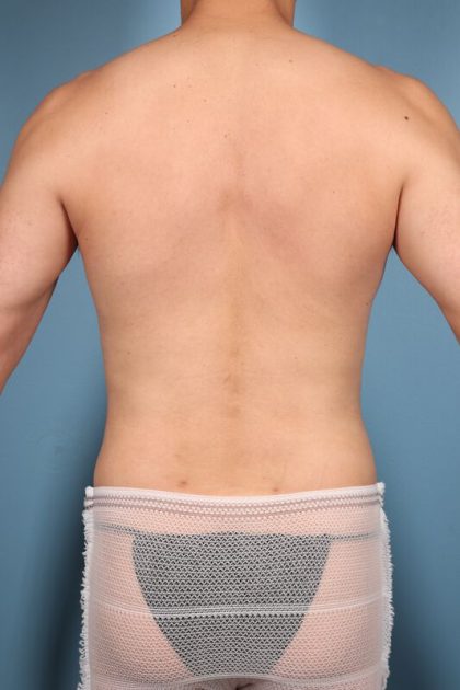 Hi-Def Liposuction Before & After Image