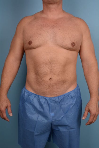 Hi-Def Liposuction Before & After Image