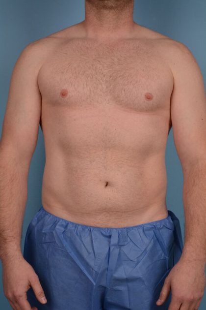 Hi-Def Liposuction Before & After Image