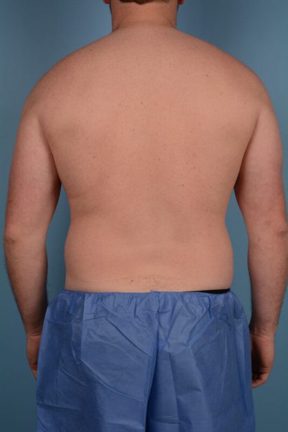 Hi-Def Liposuction Before & After Image