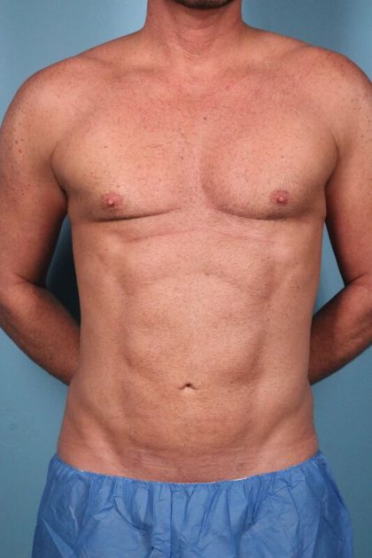 Hi-Def Liposuction Before & After Image