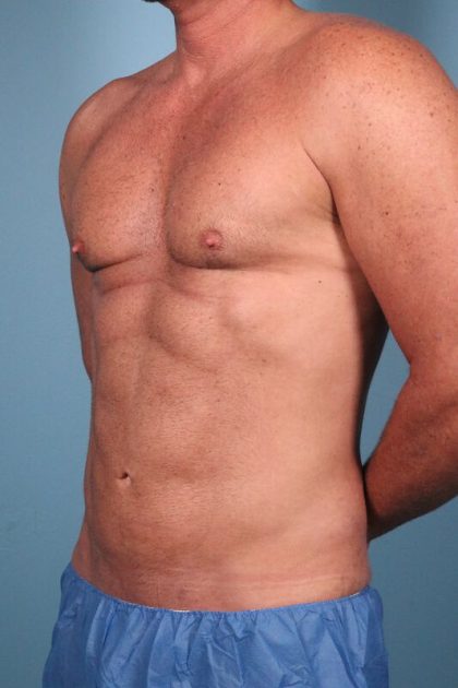 Hi-Def Liposuction Before & After Image