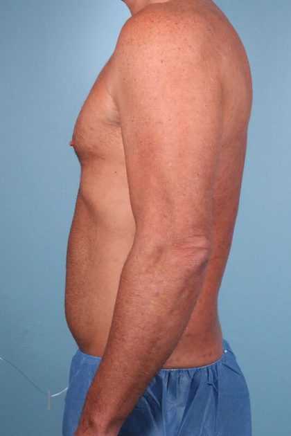 Hi-Def Liposuction Before & After Image