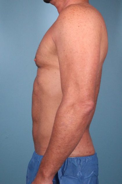 Hi-Def Liposuction Before & After Image