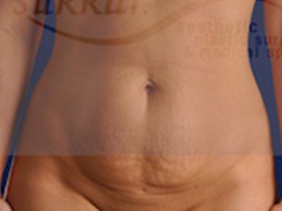 Mini Tummy Tuck Before & After Image