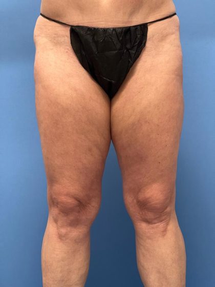 Thighplasty Before & After Image