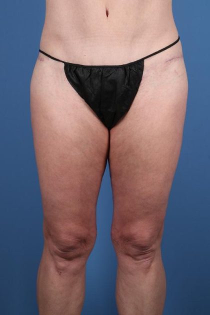 Thighplasty Before & After Image