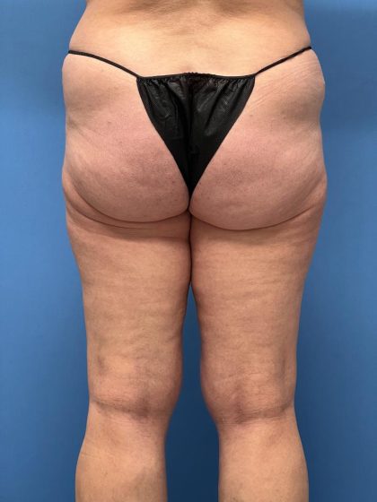 Thighplasty Before & After Image