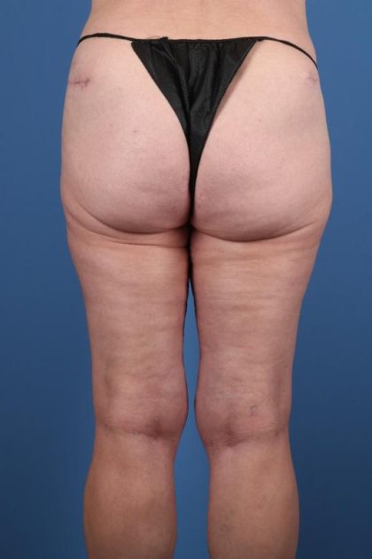 Thighplasty Before & After Image