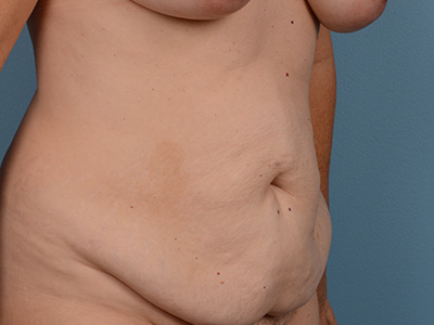 Tummy Tuck Before & After Image