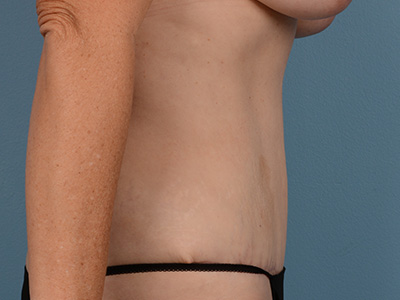 Tummy Tuck Before & After Image