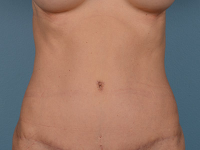 Tummy Tuck Before & After Image