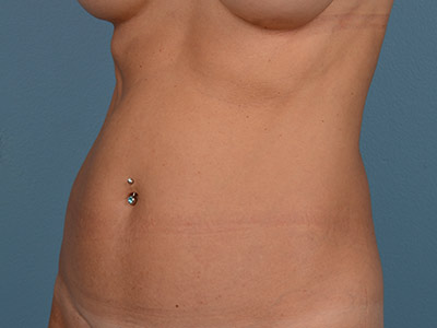 Tummy Tuck Before & After Image