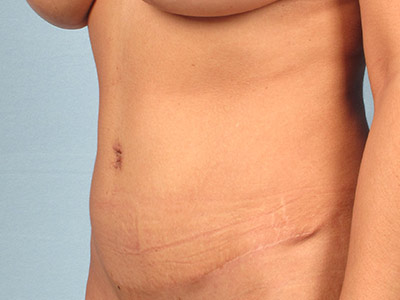 Tummy Tuck Before & After Image