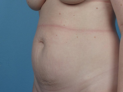 Tummy Tuck Before & After Image