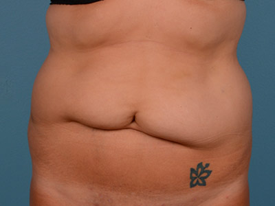 Tummy Tuck Before & After Image