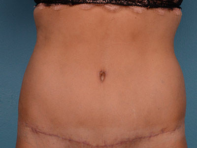 Tummy Tuck Before & After Image