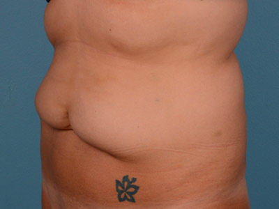 Tummy Tuck Before & After Image