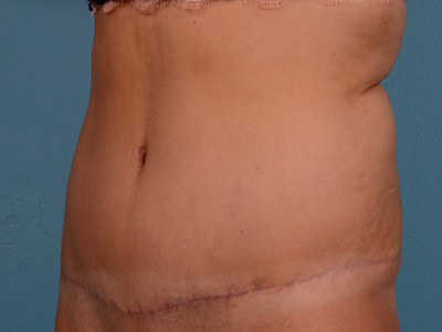 Tummy Tuck Before & After Image