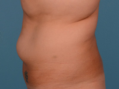 Tummy Tuck Before & After Image