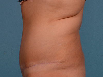 Tummy Tuck Before & After Image