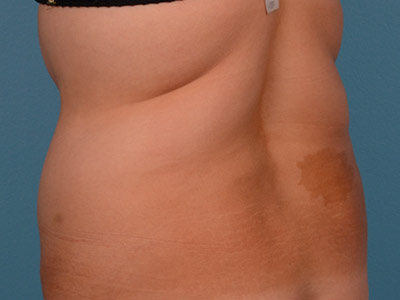 Tummy Tuck Before & After Image