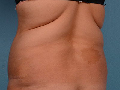 Tummy Tuck Before & After Image