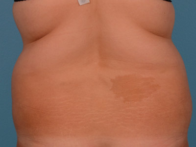 Tummy Tuck Before & After Image