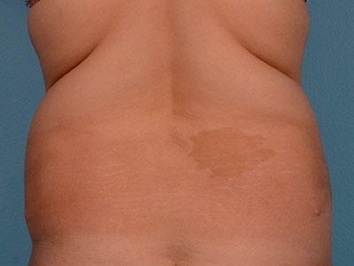 Tummy Tuck Before & After Image