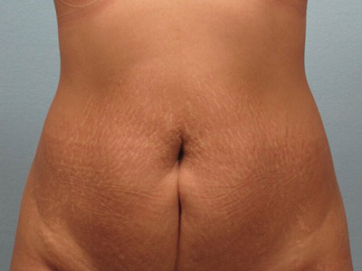 Tummy Tuck Before & After Image