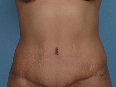 Tummy Tuck Before & After Image