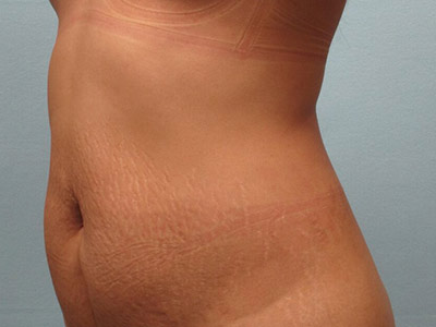 Tummy Tuck Before & After Image