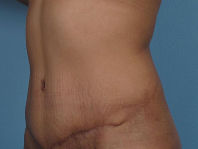 Tummy Tuck Before & After Image