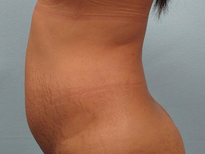 Tummy Tuck Before & After Image