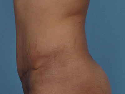 Tummy Tuck Before & After Image