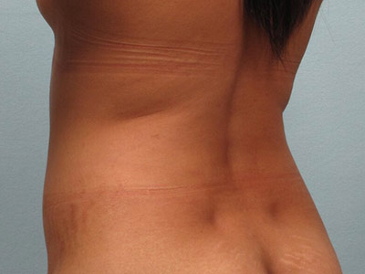 Tummy Tuck Before & After Image