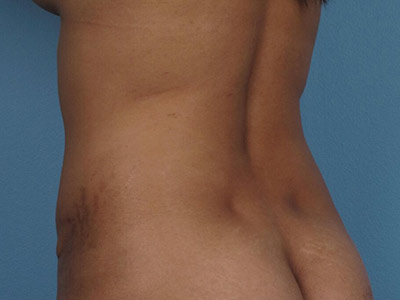 Tummy Tuck Before & After Image